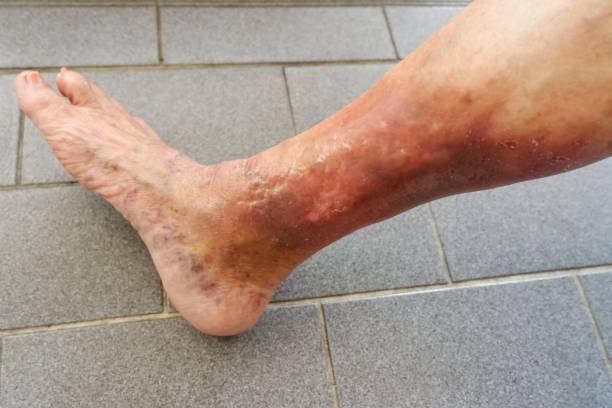Penyebab Eksim di Kaki Faktor-faktor yang Perlu Anda Ketahui